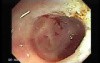 Polyp Inside Of A Diverticulum (11 of 12)