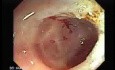 Polyp Inside Of A Diverticulum (11 of 12)