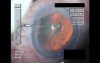 Cataract Surgery XII - Part 1
