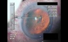 Cataract Surgery XII - Part 1