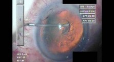 Cataract Surgery XII - Part 1