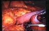 Jejunal Gastrointestinal Stromal tumor (GIST) (45 of 86)