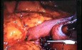 Jejunal Gastrointestinal Stromal tumor (GIST) (45 of 86)
