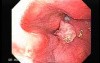 Squamous cell carcinoma of the larynx (1 of 4)