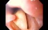 Severe Epistaxis - Case Study  (2 of 8)
