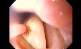 Severe Epistaxis - Case Study  (2 of 8)