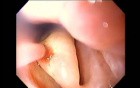 Severe Epistaxis - Case Study  (2 of 8)