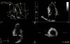 Left Ventricular Ejection Fraction (LVEF)