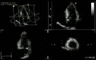 Left Ventricular Ejection Fraction (LVEF)