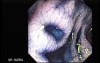 Colonoscopic Polypectomy (7 of 23)