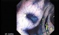 Colonoscopic Polypectomy (7 of 23)