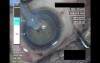 Cataract Surgery 2 - Part 1