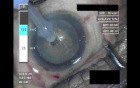 Cataract Surgery 2 - Part 1