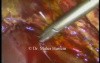 Duct of Lushka - Laparoscopic Ligation