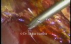 Duct of Lushka - Laparoscopic Ligation