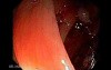 Giant Tubulo - Villous Adenoma (4 of 17)