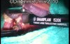 Near Total Subcapsular Tonsillotomy - Laser Technique