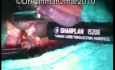 Near Total Subcapsular Tonsillotomy - Laser Technique
