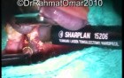 Near Total Subcapsular Tonsillotomy - Laser Technique
