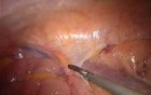 Laparoscopic right hemicolectomy