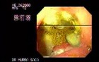 Gastric Ulcer with Fistolous Biliary Tract