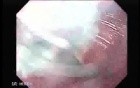 Esophageal Squamous Cell Carcinoma (2 of 2)