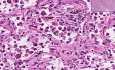 Organizing Pneumonia