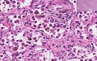 Organizing Pneumonia