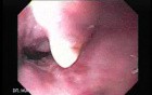 Esophageal Varix - Bleeding - 65 Years-Old Diabetic Woman
