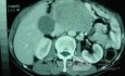 Gastric Ulcer with Gastrocolic fistula due to a Zollinger-
 Ellison Syndrome (30 of 33)