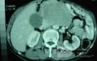 Gastric Ulcer with Gastrocolic fistula due to a Zollinger-
 Ellison Syndrome (30 of 33)