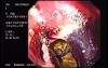Ulcerative Adenocarcinoma of the Gasrtic Fudnus With Hemorrhage