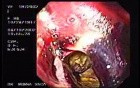 Ulcerative Adenocarcinoma of the Gasrtic Fudnus With Hemorrhage