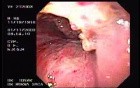Laryngeal carcinoma invading epiglottis and tongue 2/2