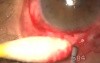 Uveitic glaucoma- transciliary filtration