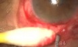Uveitic glaucoma- transciliary filtration