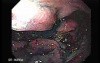 Multiple Irregular and Large Ulcers - Chromoendoscopy with Indigo Carmine Stain, Part 1