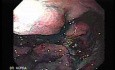 Multiple Irregular and Large Ulcers - Chromoendoscopy with Indigo Carmine Stain, Part 1