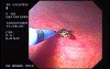 Gastric Angiodysplastic Lesions - Argon Plasma Coagulation (2 of 3)