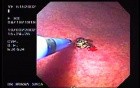 Gastric Angiodysplastic Lesions - Argon Plasma Coagulation (2 of 3)