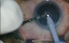 Phacoemulsification With New Horizontal Chopping