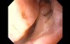 Severe Epistaxis - Case Study  (8 of 8)