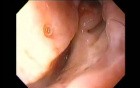 Severe Epistaxis - Case Study  (8 of 8)