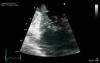 Mitral Valve Regurgitation