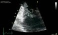 Mitral Valve Regurgitation