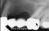 Endodontics Case - Retreat The Retreat?