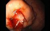 Gastric Varices - Endoscopic Ablation With Cyanoacrylate Glue (9 of 18)