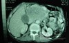 Gastric Ulcer with Gastrocolic fistula due to a Zollinger-
 Ellison Syndrome (24 of 33)