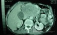 Gastric Ulcer with Gastrocolic fistula due to a Zollinger-
 Ellison Syndrome (24 of 33)