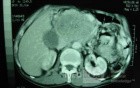 Gastric Ulcer with Gastrocolic fistula due to a Zollinger-
 Ellison Syndrome (24 of 33)